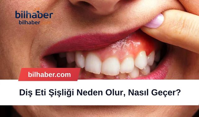 Diş Eti Şişliği Neden Olur, Nasıl Geçer?