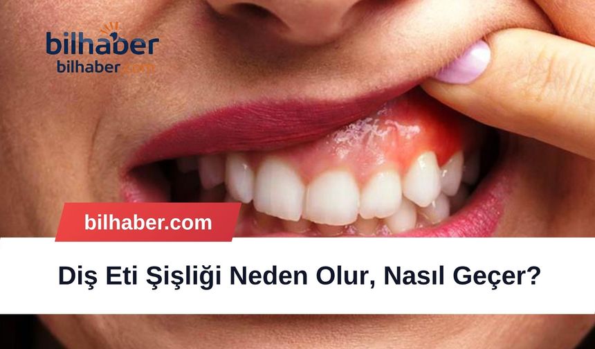 Diş Eti Şişliği Neden Olur, Nasıl Geçer?